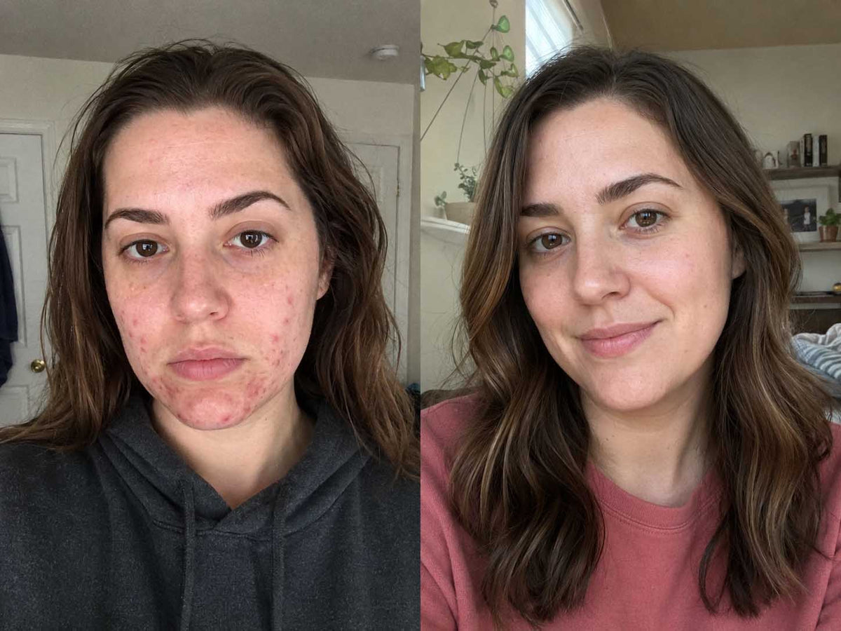 ORI1 Collagen Strips before and after