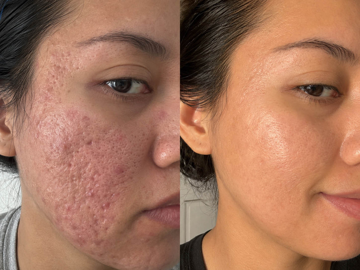 ORI1 Collagen Strips before and after
