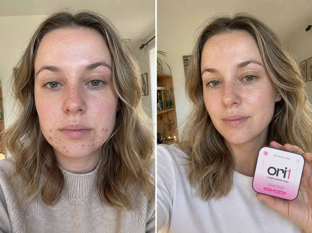 Before and after: skin texture improvement after using ORI1 collagen strips