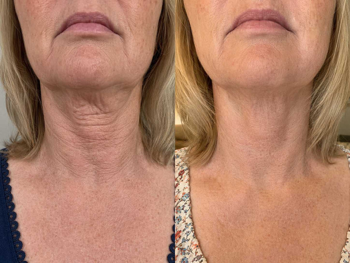 ORI1 Collagen Strips