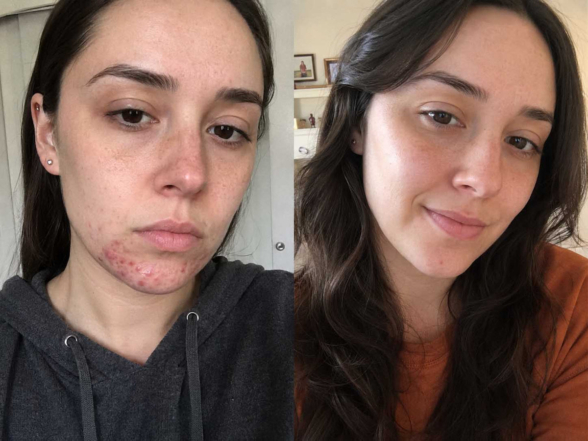 Mia R., 24 before and after