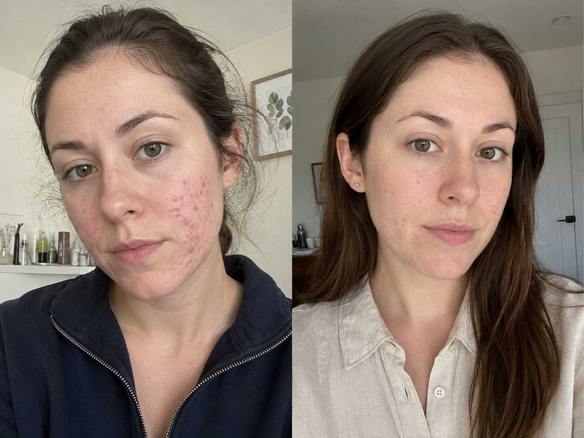 Rachel P., 25 before and after
