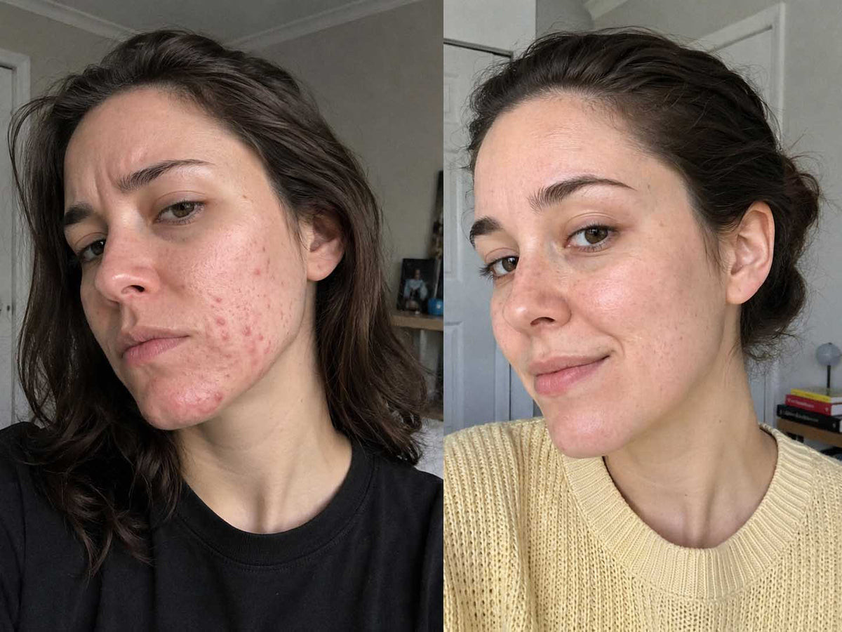 Priya S., 22 before and after