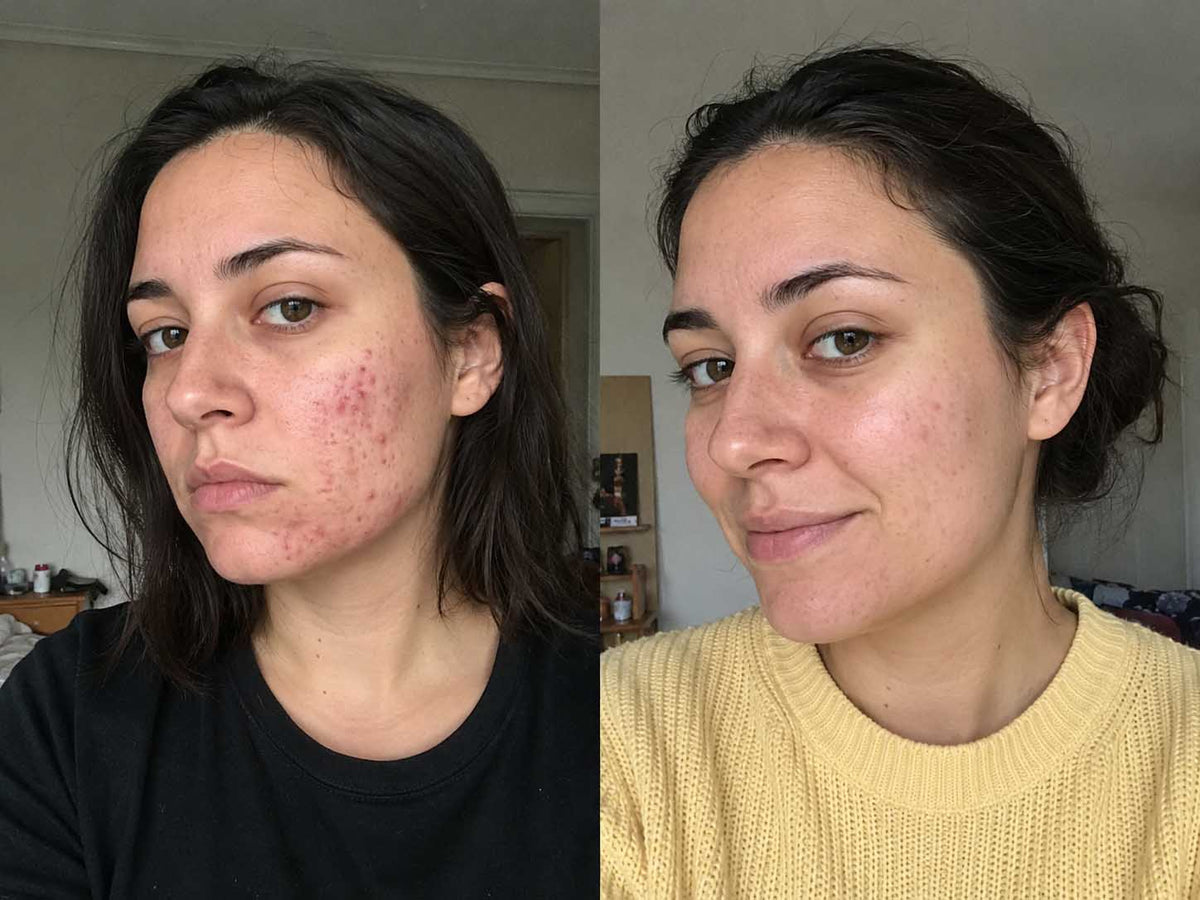 Nadia H., 23 before and after