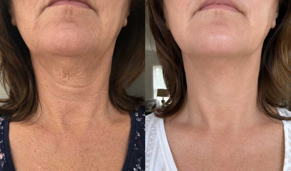 Joan W., 61 before and after
