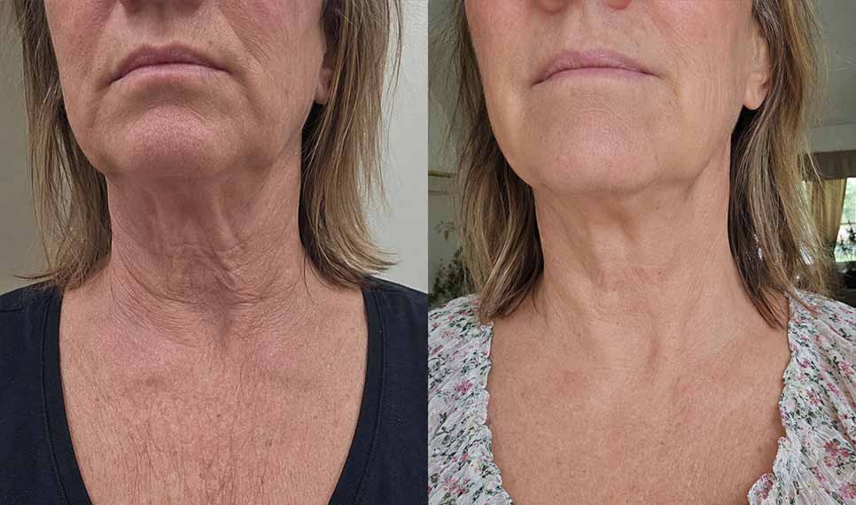 Karen K., 56 before and after