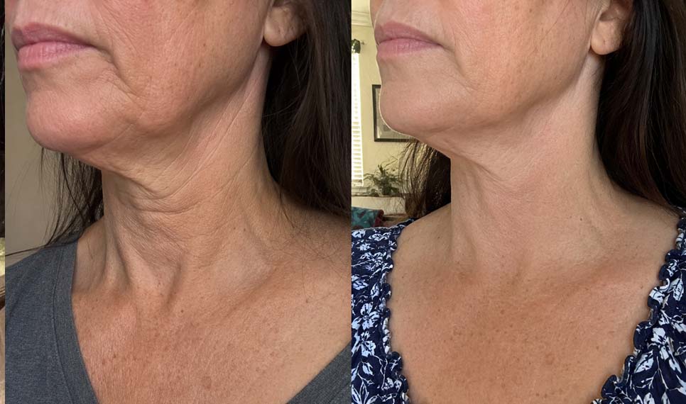 Lisa S., 55 before and after