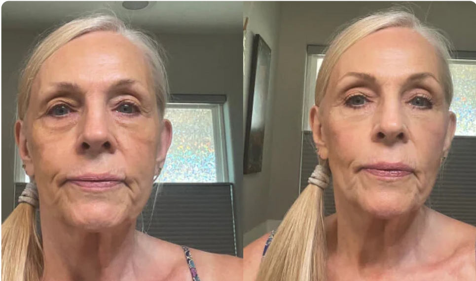 Sheila K., 74 before and after