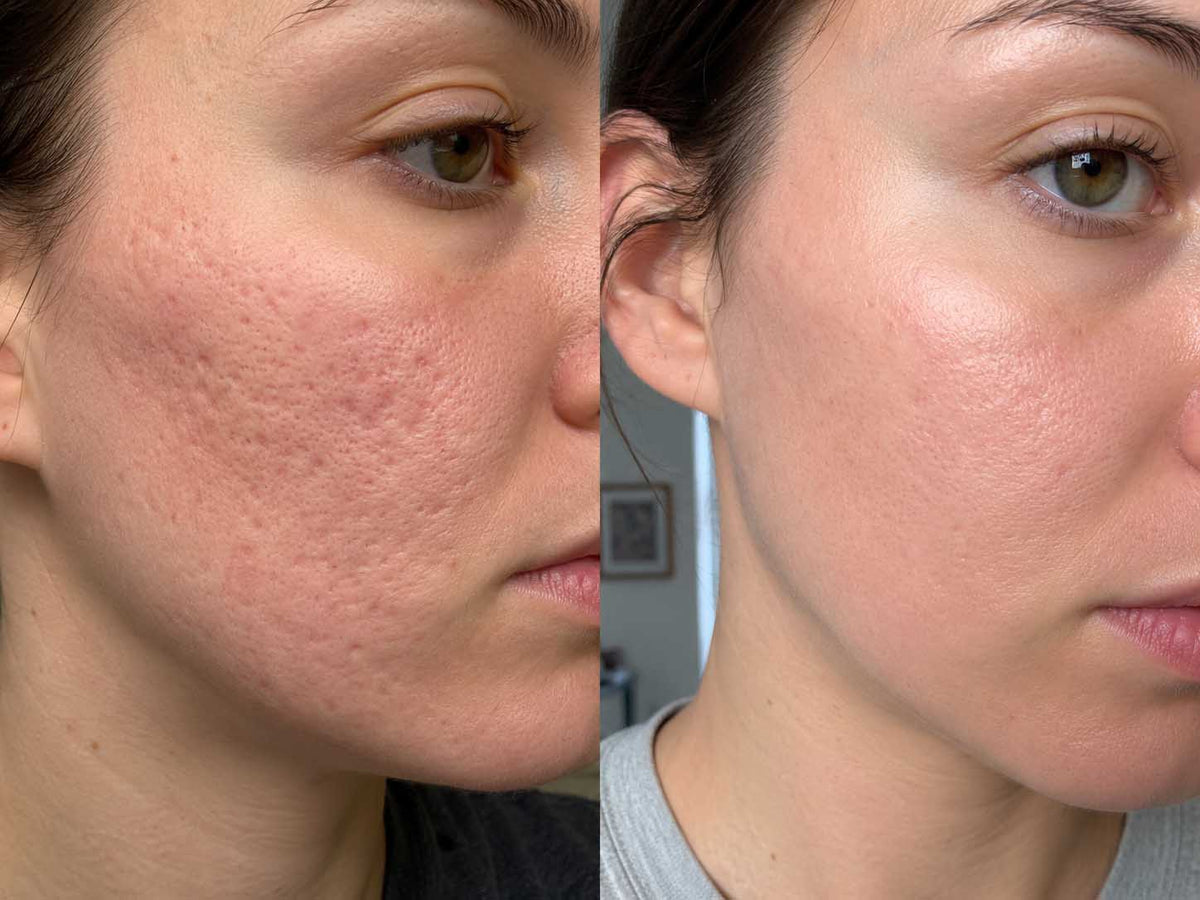 Mia R., 24 before and after