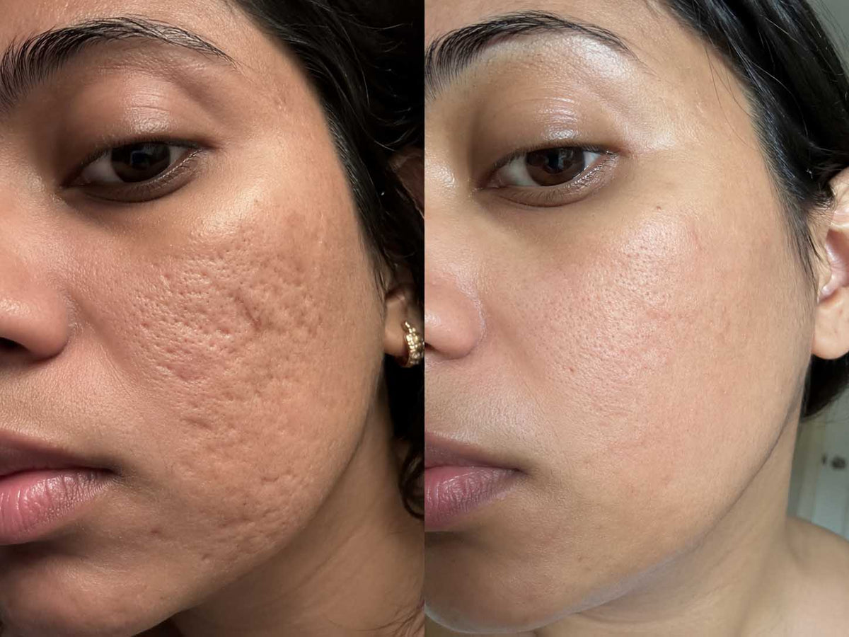 Priya S., 22 before and after