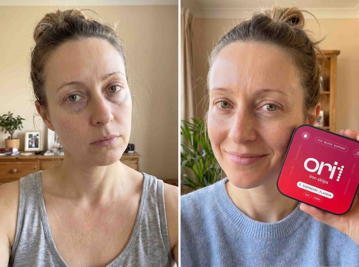 Before and after: dark circles fading after using ORI1 iron strips