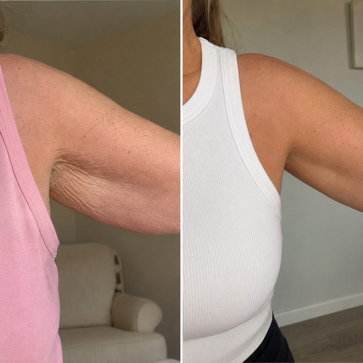 Crepey arms before and after ORI1 collagen strips
