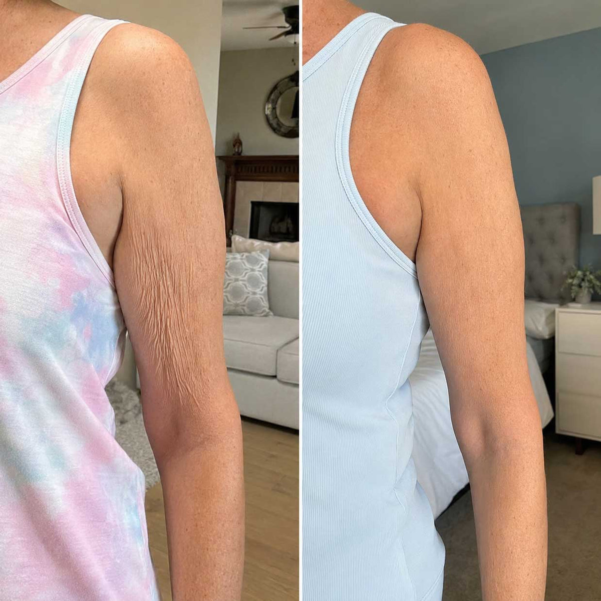 ORI1 Collagen Strips for crepey arms